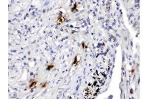 Mast Cell Tryptase was detected in paraffin-embedded sections of human lung cancer tissues using rabbit anti- Mast Cell Tryptase Antigen Affinity purified polyclonal antibody (Catalog # ) at 1 µg/mL.