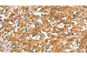 Immunohistochemistry of paraffin-embedded Human thyroid cancer tissue using ANKMY2 Polyclonal Antibody at dilution 1:30 (ANKMY2 antibody)