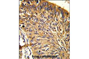 Formalin-fixed and paraffin-embedded human lung carcinoma reacted with PRDX3 Antibody (N-term), which was peroxidase-conjugated to the secondary antibody, followed by DAB staining. (Peroxiredoxin 3 antibody  (N-Term))