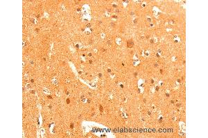 Immunohistochemistry of Human liver cancer using GRM3 Polyclonal Antibody at dilution of 1:50