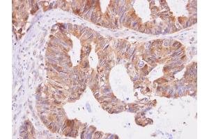 IHC-P Image Aspartyl aminopeptidase antibody [N1N3] detects Aspartyl aminopeptidase protein at cytoplasm on human colon carcinoma by immunohistochemical analysis. (Aspartyl Aminopeptidase antibody)