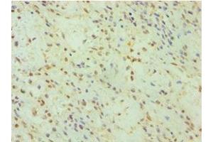 Immunohistochemistry of paraffin-embedded human breast cancer using ABIN7153663 at dilution of 1:100 (Non-Syndromic Hearing Impairment Protein 5 (GSDME) (AA 1-260) antibody)