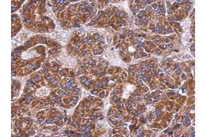 IHC-P Image Immunohistochemical analysis of paraffin-embedded human hepatoma, using C4 binding protein B, antibody at 1:500 dilution. (C4BPB antibody)