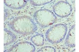 Immunohistochemistry of paraffin-embedded human colon cancer using ABIN7156024 at dilution of 1:100 (HYOU1 antibody  (AA 1-140))