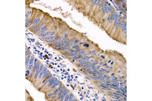 Immunohistochemistry of paraffin-embedded human colon cancer using IL9 antibody (ABIN3015677, ABIN3015678, ABIN1680463 and ABIN6219030) at dilution of 1:200 (40x lens). (IL-9 antibody  (AA 19-144))