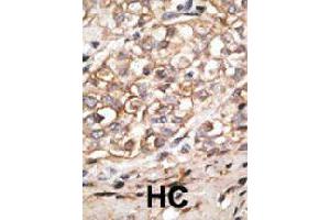 Formalin-fixed and paraffin-embedded human hepatocellular carcinoma tissue reacted with SIGLEC11 polyclonal antibody  , which was peroxidase-conjugated to the secondary antibody, followed by AEC staining. (SIGLEC11 antibody  (C-Term))