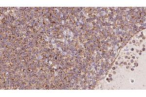 ABIN6273181 at 1/100 staining Human lymph cancer tissue by IHC-P. (TRIM9 antibody  (N-Term))