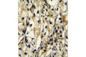 BCAT1 Antibody (Center) (ABIN654106 and ABIN2843989) immunohistochemistry analysis in formalin fixed and paraffin embedded human kidney carcinoma followed by peroxidase conjugation of the secondary antibody and DAB staining. (BCAT1 antibody  (AA 81-107))