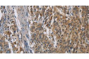Immunohistochemistry of paraffin-embedded Human gastic cancer using SIGMAR1 Polyclonal Antibody at dilution of 1:50 (SIGMAR1 antibody)