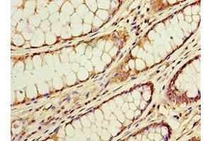 Immunohistochemistry of paraffin-embedded human colon cancer using ABIN7143228 at dilution of 1:100