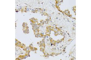 Immunohistochemistry of paraffin-embedded human lung cancer using  antibody (ABIN6129884, ABIN6137152, ABIN6137153 and ABIN6214229) at dilution of 1:100 (40x lens). (ART1 antibody  (AA 23-295))
