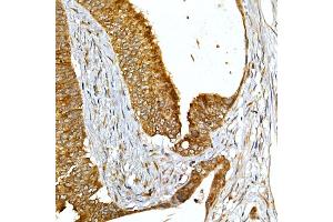 Immunohistochemistry of paraffin-embedded human colon carcinoma using VAPB Rabbit pAb (ABIN6132783, ABIN6150058, ABIN6150059 and ABIN6221003) at dilution of 1:50 (40x lens). (VAPB antibody  (AA 10-222))