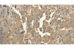 Immunohistochemistry of paraffin-embedded Human ovarian cancer using PSMD9 Polyclonal Antibody at dilution of 1:50 (PSMD9 antibody)