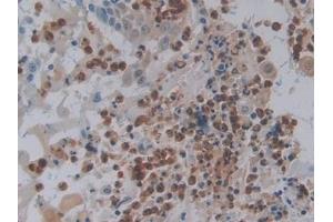 Detection of FOS in Human Skin cancer Tissue using Polyclonal Antibody to V-Fos FBJ Murine Osteosarcoma Viral Oncogene Homolog (FOS) (FOS antibody  (AA 55-298))