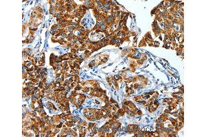Immunohistochemistry of Human lung cancer using ALDH6A1 Polyclonal Antibody at dilution of 1:45