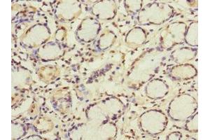 Immunohistochemistry of paraffin-embedded human gastric cancer using ABIN7154322 at dilution of 1:100 (GBF1 antibody  (AA 1-85))