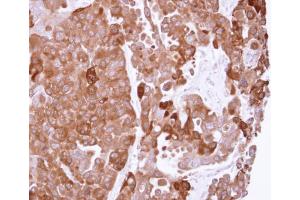 IHC-P Image Immunohistochemical analysis of paraffin-embedded OVCAR3 xenograft, using PPA1, antibody at 1:500 dilution. (Pyrophosphatase (Inorganic) 1 (PPA1) antibody)