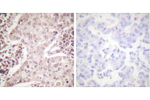 Peptide - +Immunohistochemical analysis of paraffin-embedded human breast carcinoma tissue using Chk2 (Ab-387) Antibody (#B0414). (CHEK2 antibody  (Thr387))