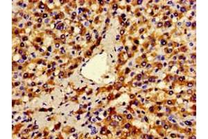 Immunohistochemistry of paraffin-embedded human liver cancer using ABIN7144300 at dilution of 1:100