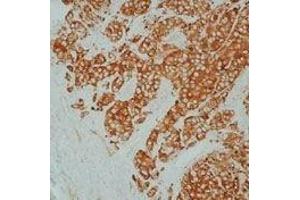 Formalin-fixed, paraffin-embedded  human breast carcinoma stained with Heat Shock Protein 27  using peroxidase-  conjugate and DAB chromogen. (HSP27 antibody)