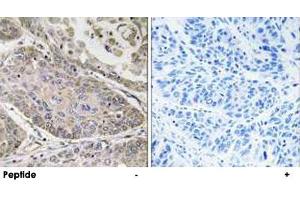 Immunohistochemistry analysis of paraffin-embedded human lung carcinoma tissue using PLA2G4E polyclonal antibody . (PLA2G4E antibody)