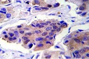 Immunohistochemistry (IHC) analyzes of GSK3alpha pAb in paraffin-embedded human breast carcinoma tissue. (GSK3 alpha antibody)