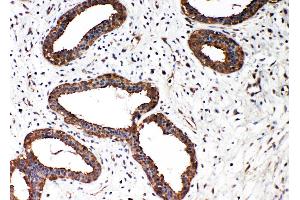 Anti-Smad2 antibody, IHC(P) IHC(P): Human Mammary Cancer Tissue (SMAD2 antibody  (N-Term))