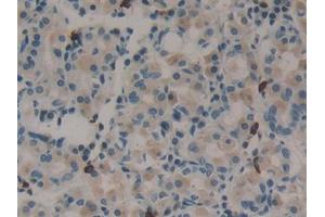 IHC-P analysis of Human Stomach cancer Tissue, with DAB staining. (Midkine antibody  (AA 22-143))