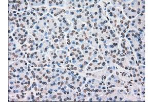 Immunohistochemical staining of paraffin-embedded Adenocarcinoma of ovary tissue using anti-CHEK2mouse monoclonal antibody. (CHEK2 antibody)