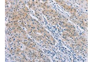 The image on the left is immunohistochemistry of paraffin-embedded Human gastric cancer tissue using ABIN7189712(AGAP2 Antibody) at dilution 1/30, on the right is treated with synthetic peptide.