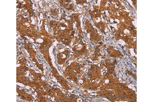 Immunohistochemistry of Human breast cancer using DCTN6 Polyclonal Antibody at dilution of 1:40 (DCTN6 antibody)