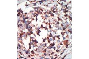 Formalin-fixed and paraffin-embedded human cancer tissue reacted with the primary antibody, which was peroxidase-conjugated to the secondary antibody, followed by AEC staining. (PKC beta antibody  (C-Term))