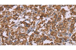 Immunohistochemistry of paraffin-embedded Human thyroid cancer using Cyclophilin F Polyclonal Antibody at dilution of 1:45 (PPIF antibody)