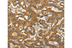 Immunohistochemistry of Human thyroid cancer using ADCY3 Polyclonal Antibody at dilution of 1:50 (ADCY3 antibody)