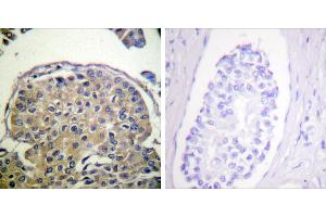 P-peptide - +Immunohistochemistry analysis of paraffin-embedded human breast carcinoma tissue using CD227/Mucin 1 (Phospho-Tyr1243) antibody. (MUC1 antibody  (pTyr1243))