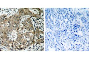 Peptide - +Immunohistochemical analysis of paraffin-embedded human breast carcinoma tissue using FKHR (Ab-319) antibody (#B7086). (FOXO1 antibody  (Ser319))