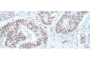 Immunohistochemistry of paraffin-embedded Human colorectal cancer tissue using HCRT Polyclonal Antibody at dilution of 1:25(x200) (Orexin antibody)