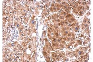IHC-P Image StAR antibody detects StAR protein at cytosol on human hepatoma by immunohistochemical analysis. (STAR antibody)