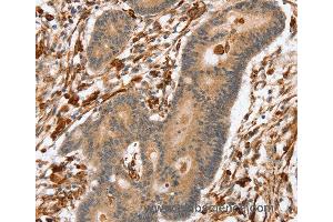 Immunohistochemistry of Human colon cancer using SSX2IP Polyclonal Antibody at dilution of 1:45 (SSX2IP antibody)