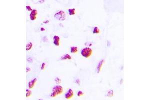 Immunohistochemical analysis of C/EBP beta staining in human lung cancer formalin fixed paraffin embedded tissue section. (CEBPB antibody  (C-Term))