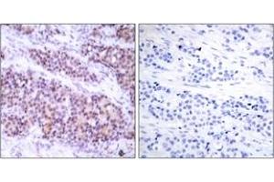 Immunohistochemistry analysis of paraffin-embedded human breast carcinoma, using BCL-XL (Phospho-Ser62) Antibody. (BCL2L1 antibody  (pSer62))