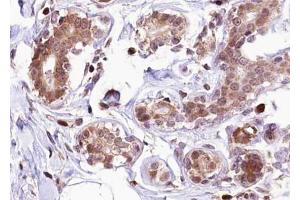 ABIN6267278 at 1/100 staining human Breast carcinoma tissue sections by IHC-P. (Estrogen Receptor alpha antibody  (pSer118))