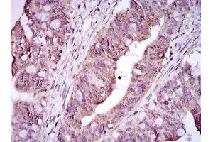Immunohistochemical analysis of paraffin-embedded rectum cancer tissues using ITGA2B mouse mAb with DAB staining. (Integrin Alpha2b antibody  (AA 45-149))