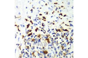 Immunohistochemistry of paraffin-embedded human liver cancer using CAPG Antibody (ABIN6132242, ABIN6137908, ABIN6137909 and ABIN7101810) at dilution of 1:100 (40x lens). (CAPG antibody  (AA 1-348))