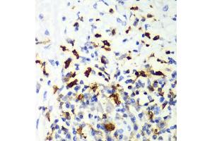 Immunohistochemistry of paraffin-embedded human liver cancer using CAPG Antibody (ABIN6132242, ABIN6137908, ABIN6137909 and ABIN7101810) at dilution of 1:100 (40x lens). (CAPG antibody  (AA 1-348))
