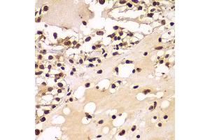 Immunohistochemistry of paraffin-embedded human kidney cancer using ZNF20 antibody at dilution of 1:100 (x400 lens).