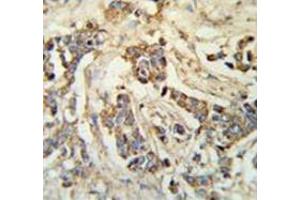 Immunohistochemistry analysis in breast carcinoma (Formalin-fixed, Paraffin-embedded) using MRAP Antibody (N-term), followed by peroxidase conjugated secondary antibody and DAB staining. (MRAP antibody  (N-Term))