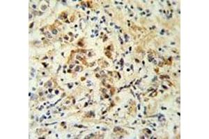 Bid antibody IHC analysis in formalin fixed and paraffin embedded human breast carcinoma. (BID antibody  (AA 39-68))