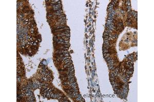 Immunohistochemistry of Human colon cancer using HMGCL Polyclonal Antibody at dilution of 1:30 (HMGCL antibody)