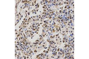Immunohistochemistry of paraffin-embedded human lung cancer tissue using H4R3me2a antibody at dilution of 1:200 (x400 lens)